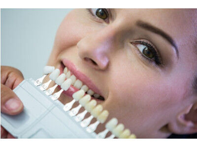 Beautiful Dental Veneers in San Antonio 